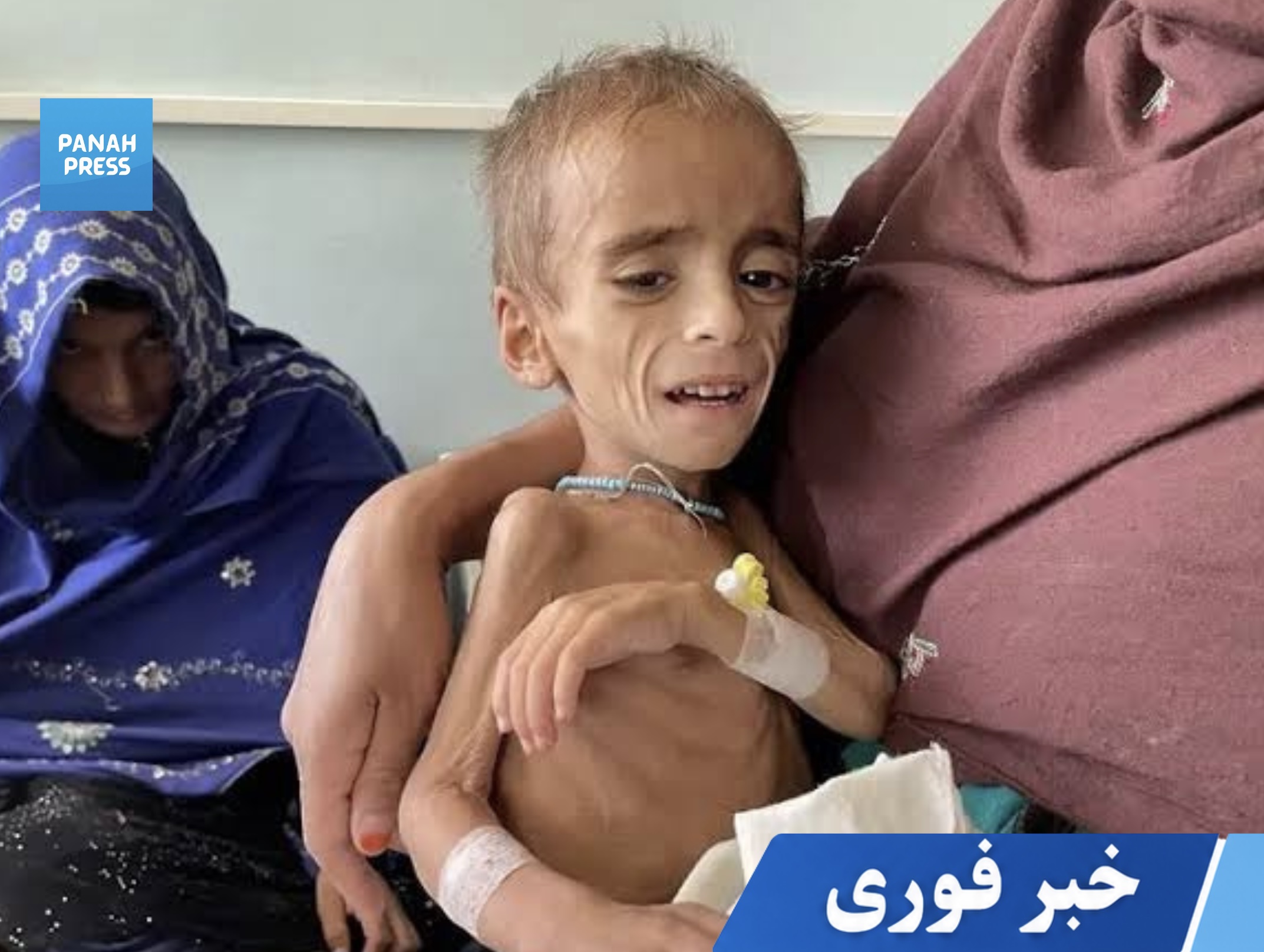 UNICEF Warns: 3.7 Million Afghan Children at Risk of Malnutrition